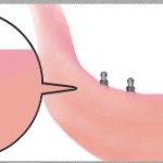 fog implantátum